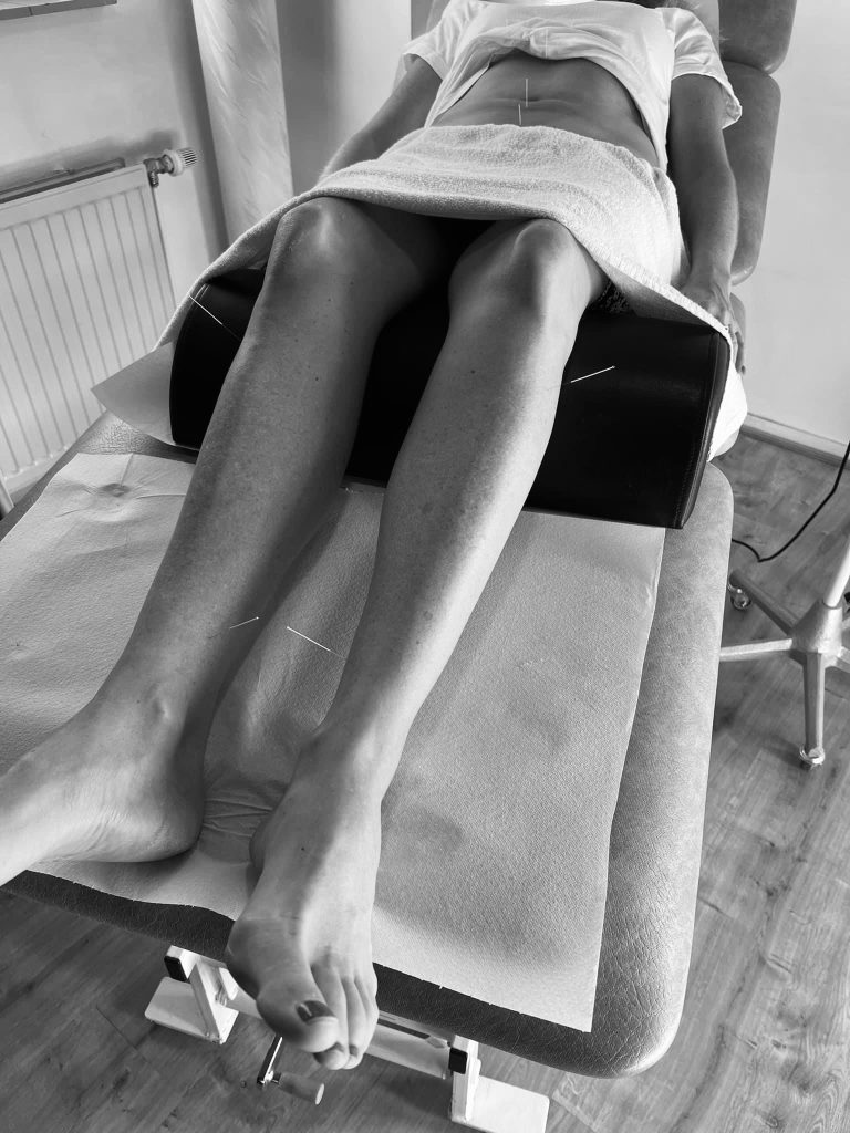 Acupunctuur Hoorn behandeling
