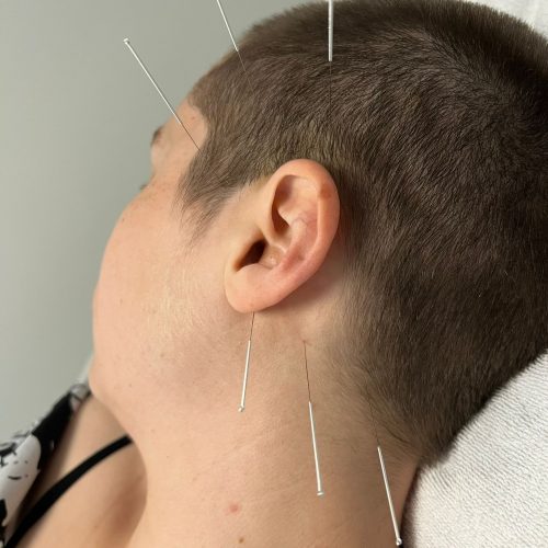 Acupunctuurnaalden op het hoofd, de slapen en de nek van een patiënt.