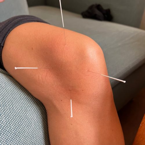 Acupunctuur behandeling in knie